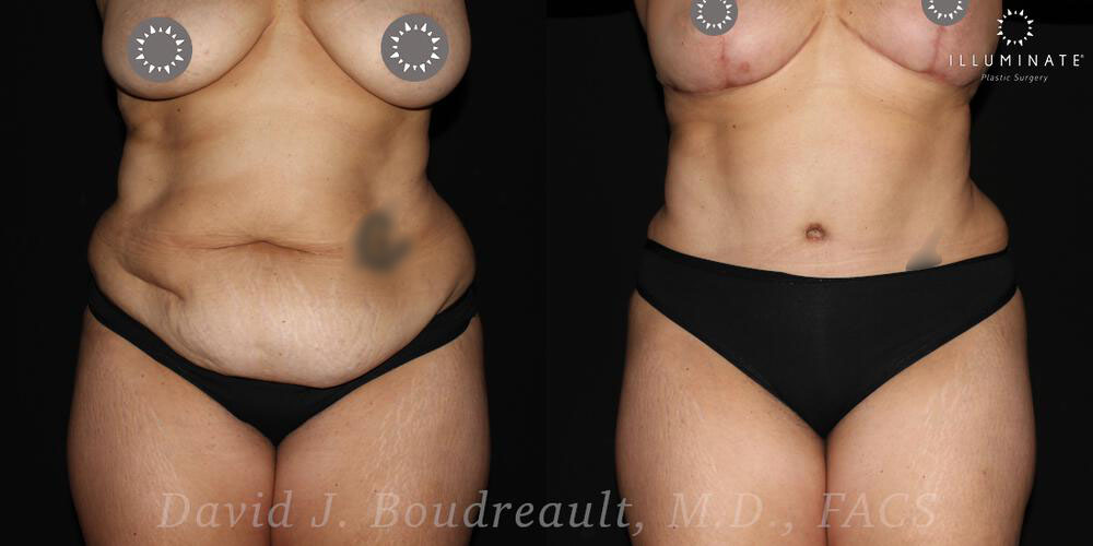 Tummy Tuck Before & After Image