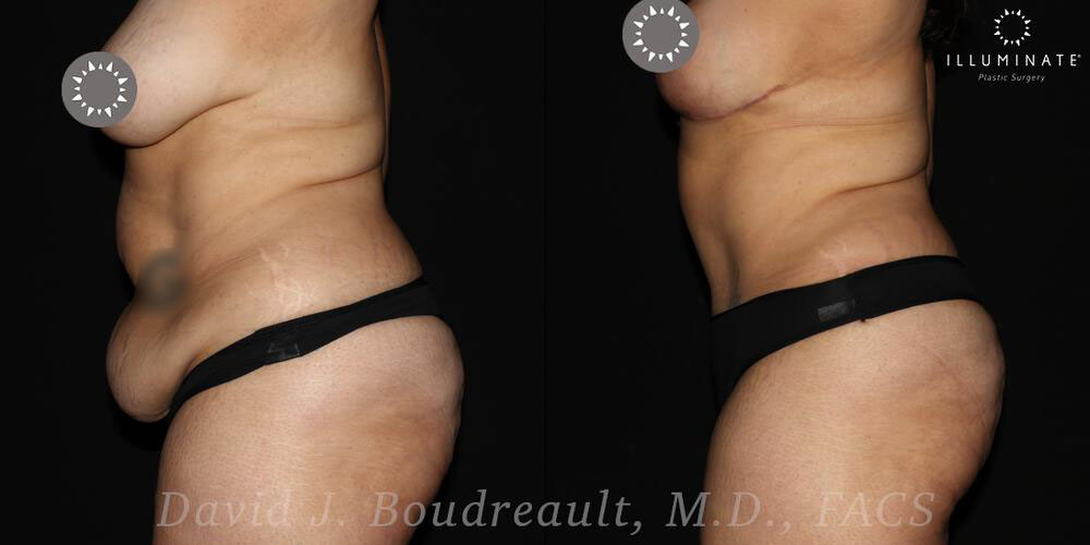 Tummy Tuck Before & After Image