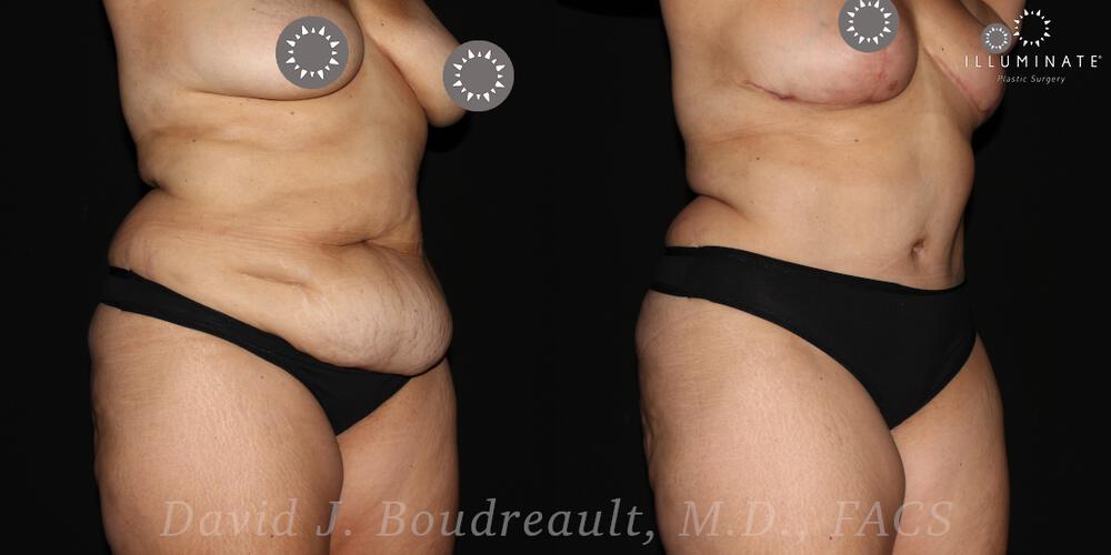 Tummy Tuck Before & After Image