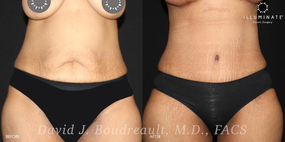 Tummy Tuck Before & After Image