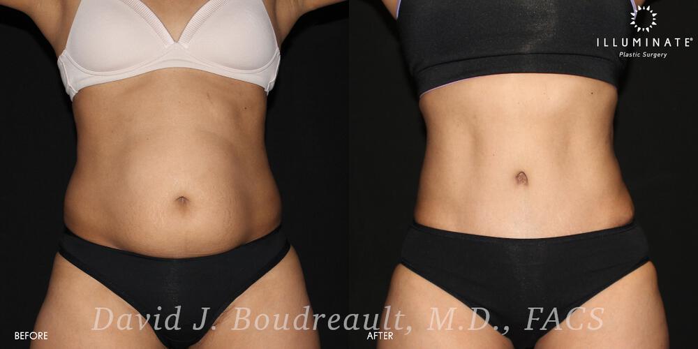 Tummy Tuck Before & After Image