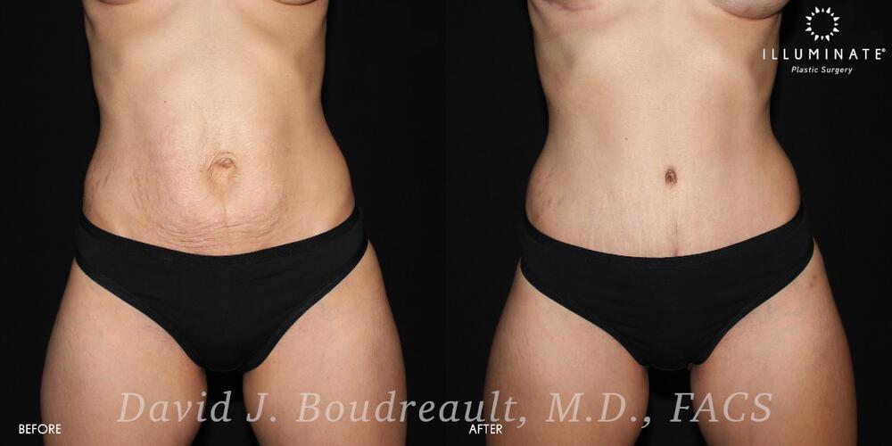 Tummy Tuck Before & After Image