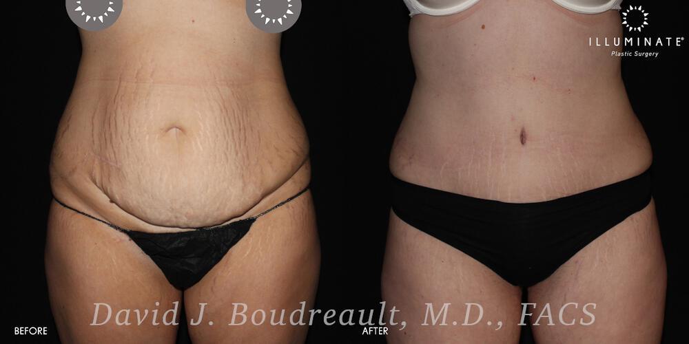 Tummy Tuck Before & After Image