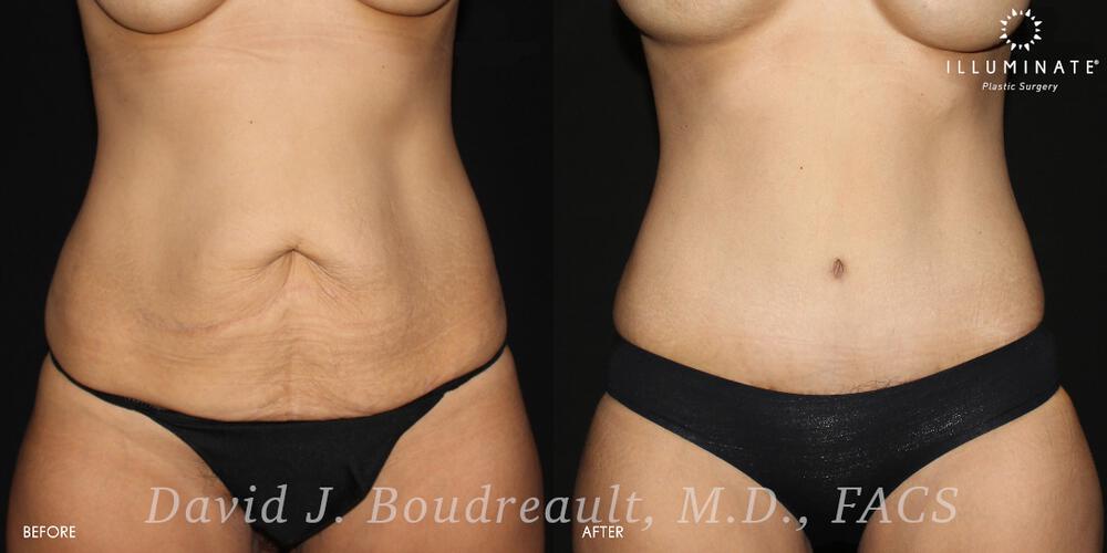 Tummy Tuck Before & After Image