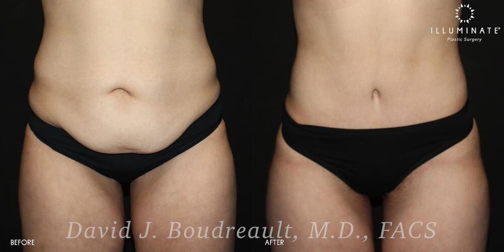 Tummy Tuck Before & After Image