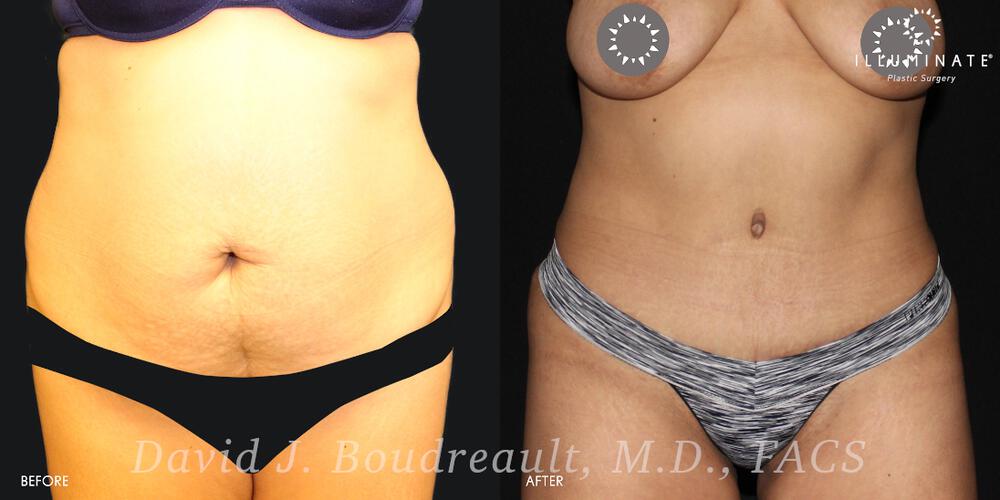 Tummy Tuck Before & After Image