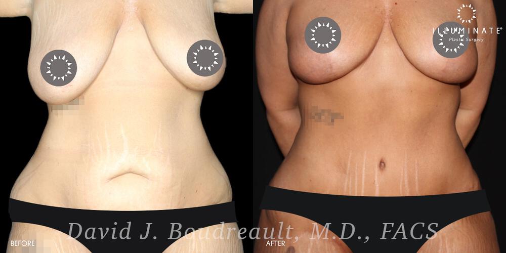 Tummy Tuck Before & After Image