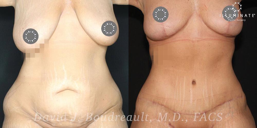 Tummy Tuck Before & After Image