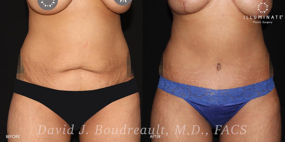 Tummy Tuck Before & After Image