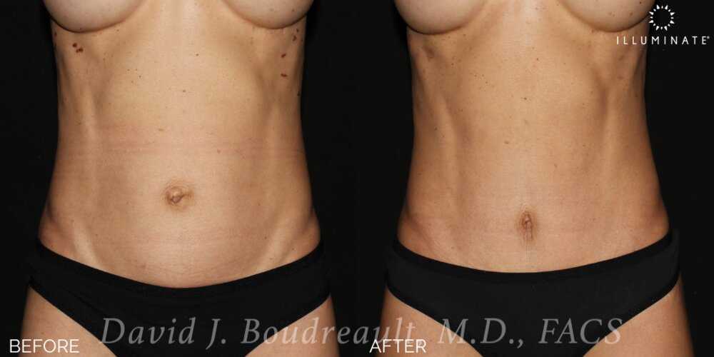 Tummy Tuck Before & After Image