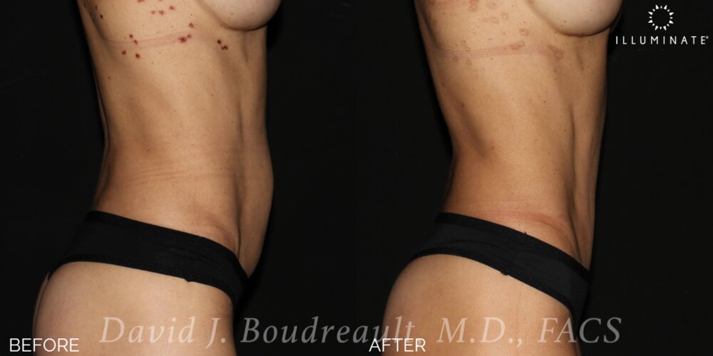 Tummy Tuck Before & After Image