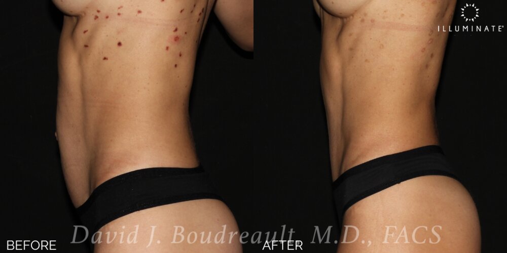 Tummy Tuck Before & After Image