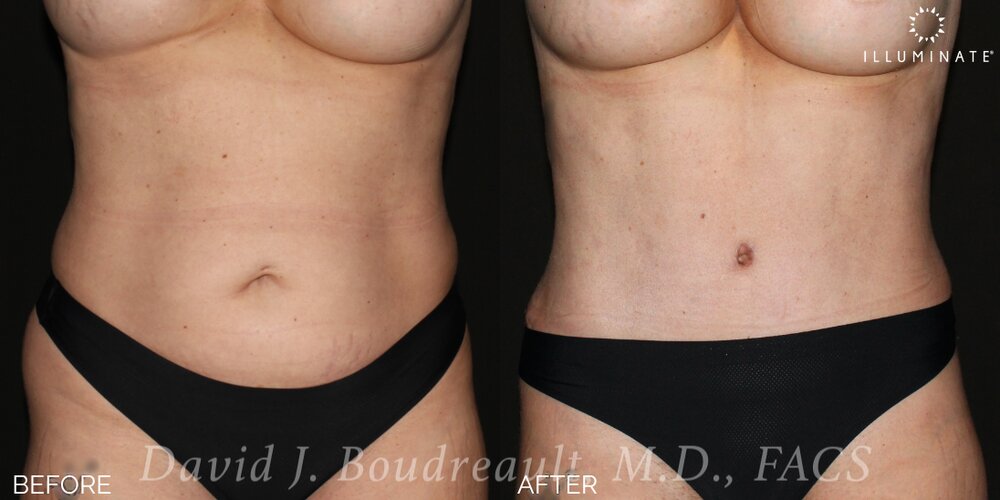 Tummy Tuck Before & After Image