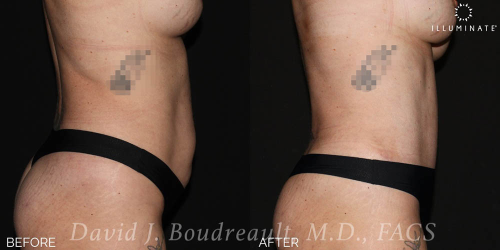 Tummy Tuck Before & After Image