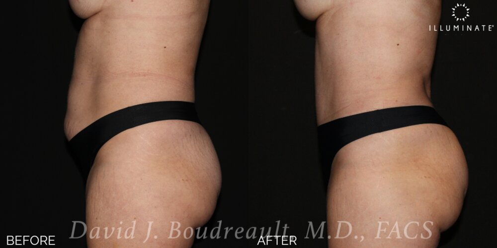 Tummy Tuck Before & After Image