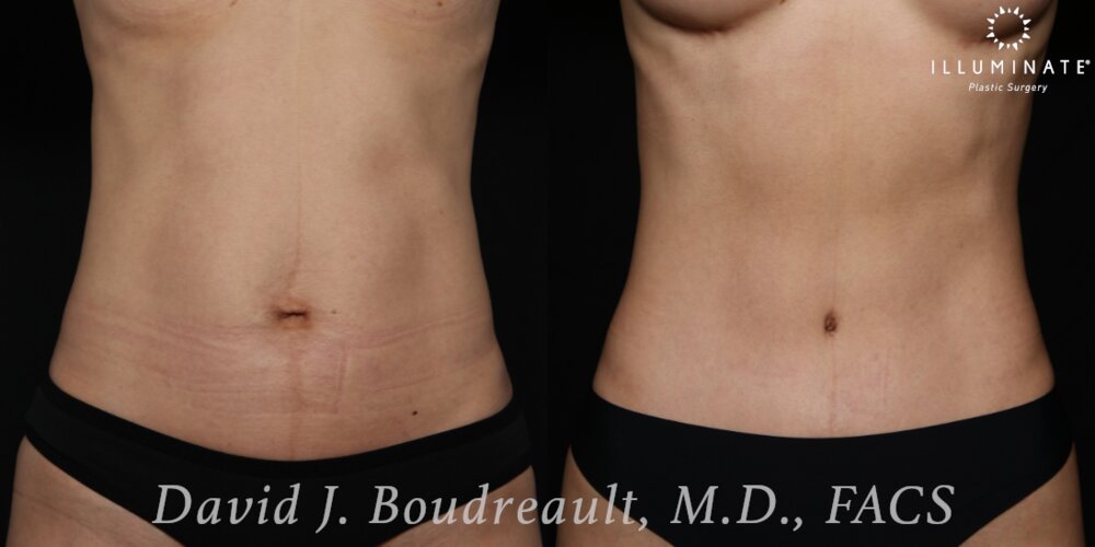 Tummy Tuck Before & After Image