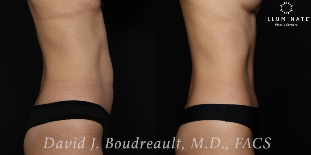 Tummy Tuck Before & After Image