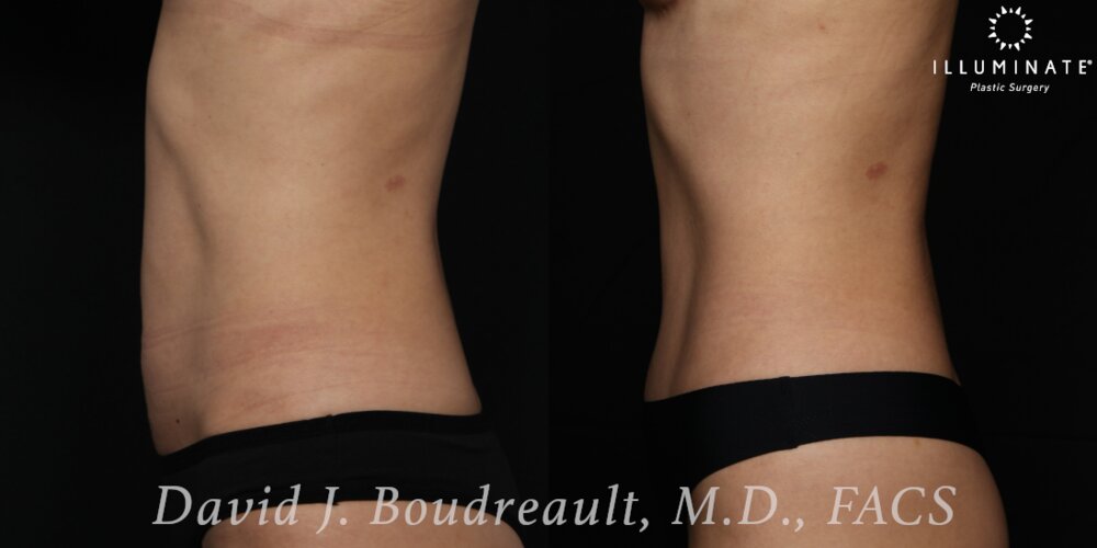 Tummy Tuck Before & After Image