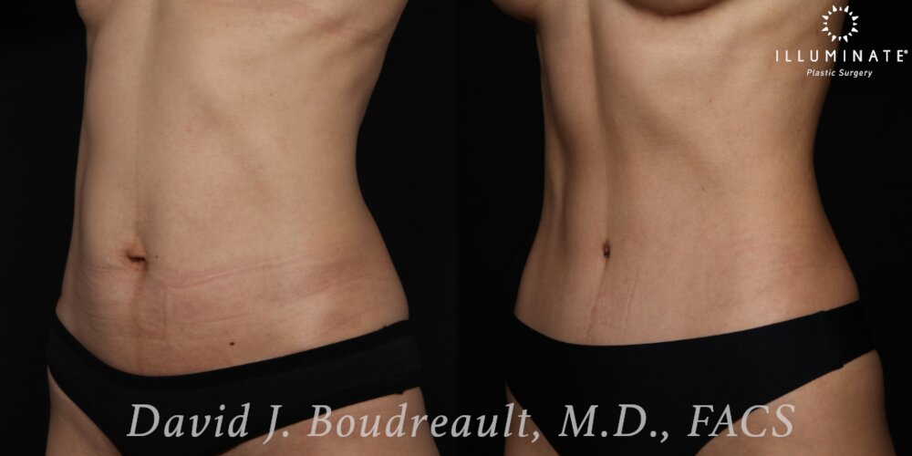 Tummy Tuck Before & After Image