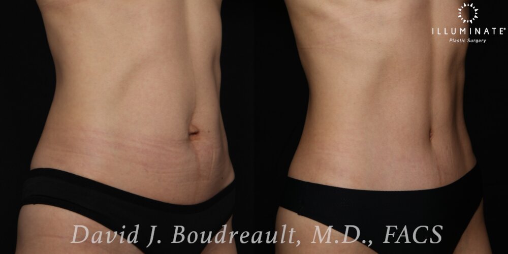 Tummy Tuck Before & After Image