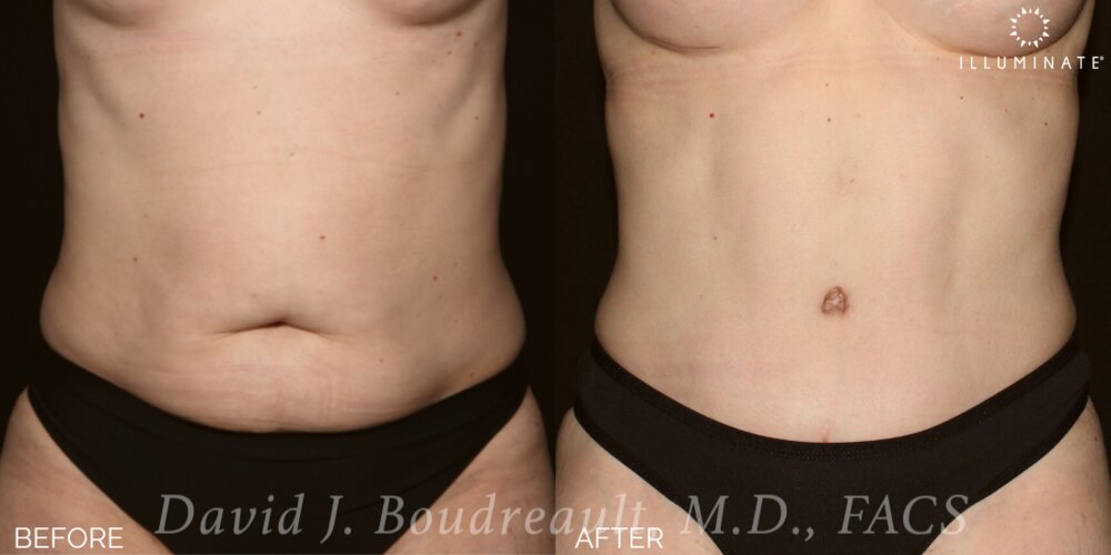 Tummy Tuck Before & After Image