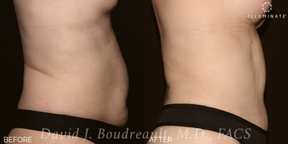 Tummy Tuck Before & After Image