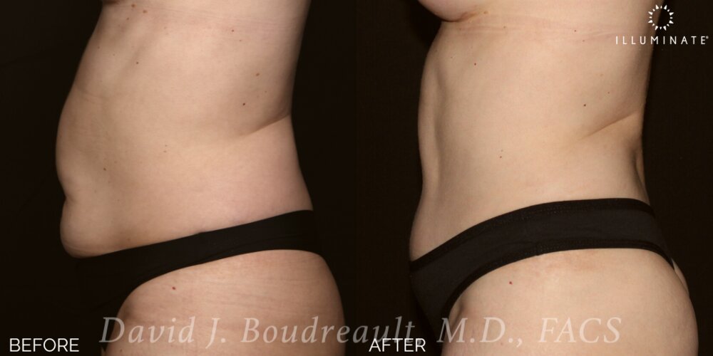 Tummy Tuck Before & After Image