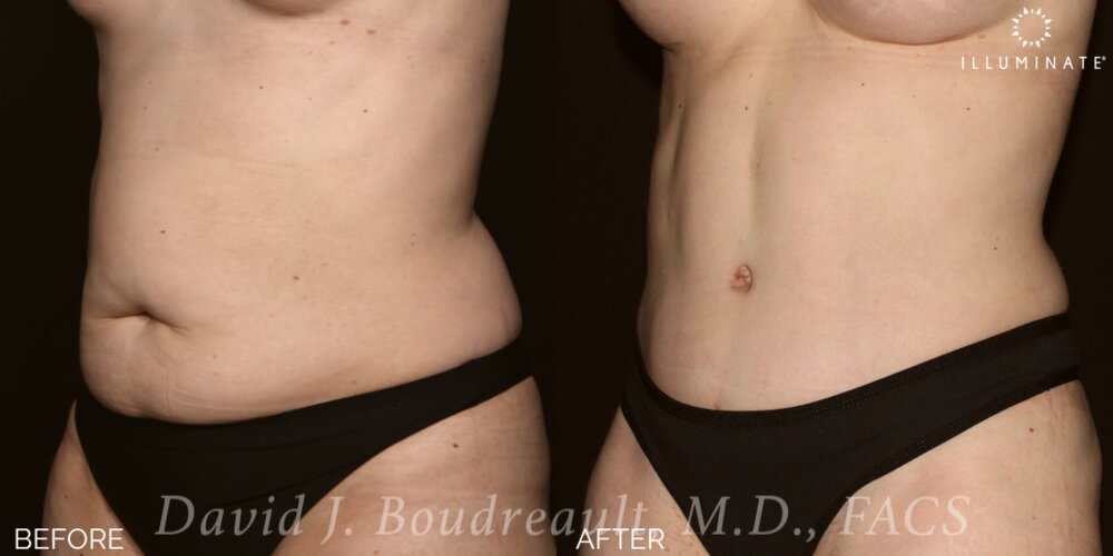 Tummy Tuck Before & After Image