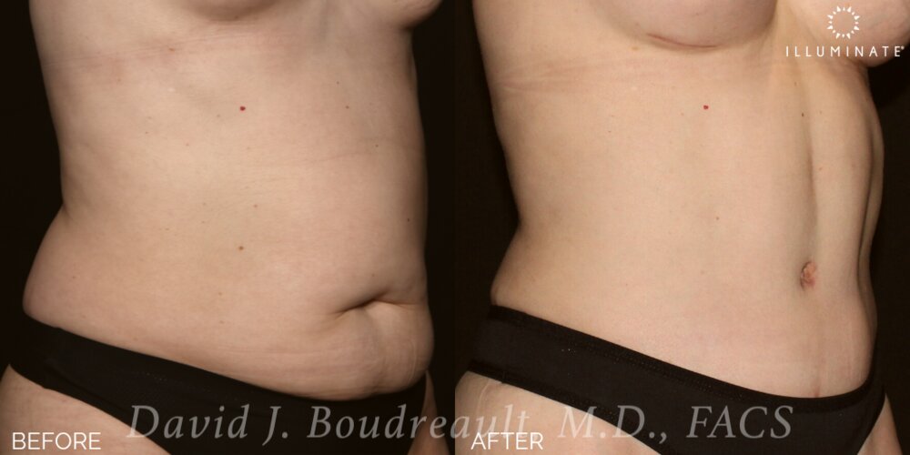 Tummy Tuck Before & After Image