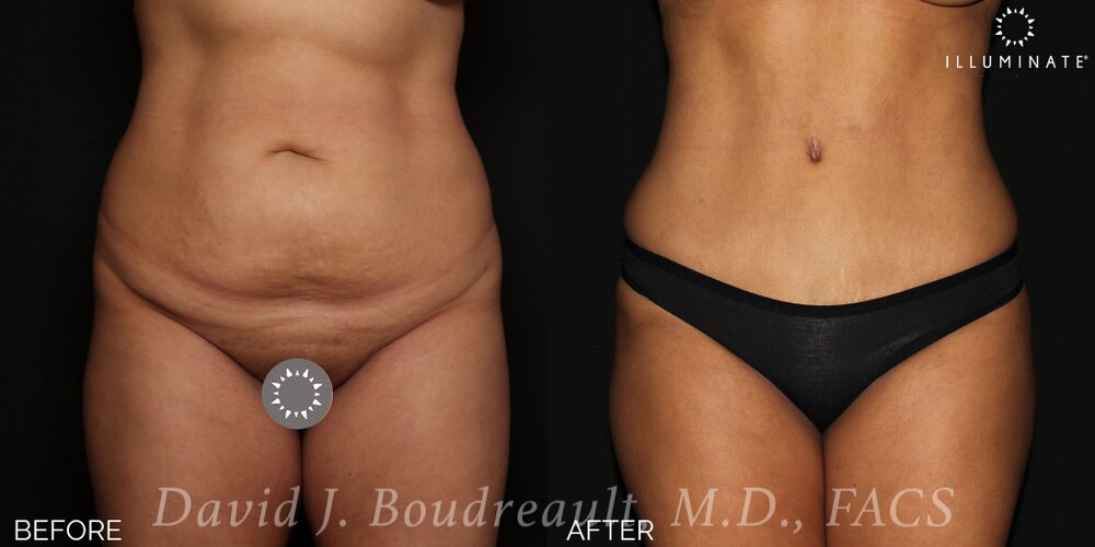 Tummy Tuck Before & After Image