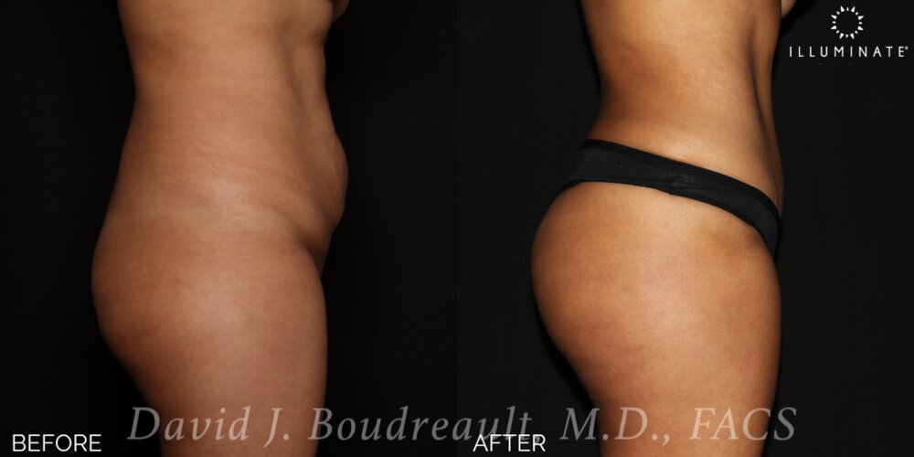 Tummy Tuck Before & After Image