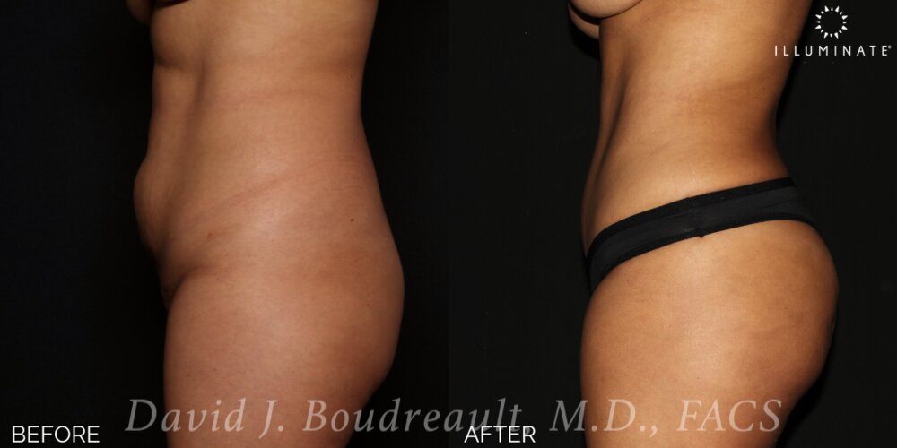 Tummy Tuck Before & After Image