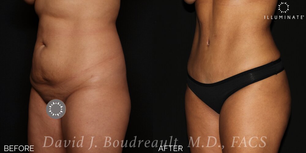 Tummy Tuck Before & After Image