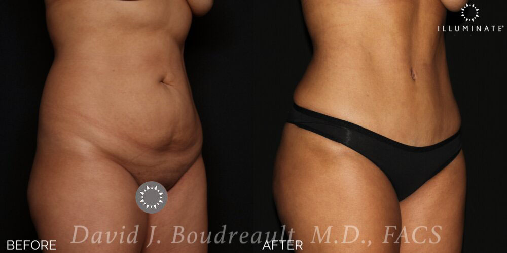 Tummy Tuck Before & After Image