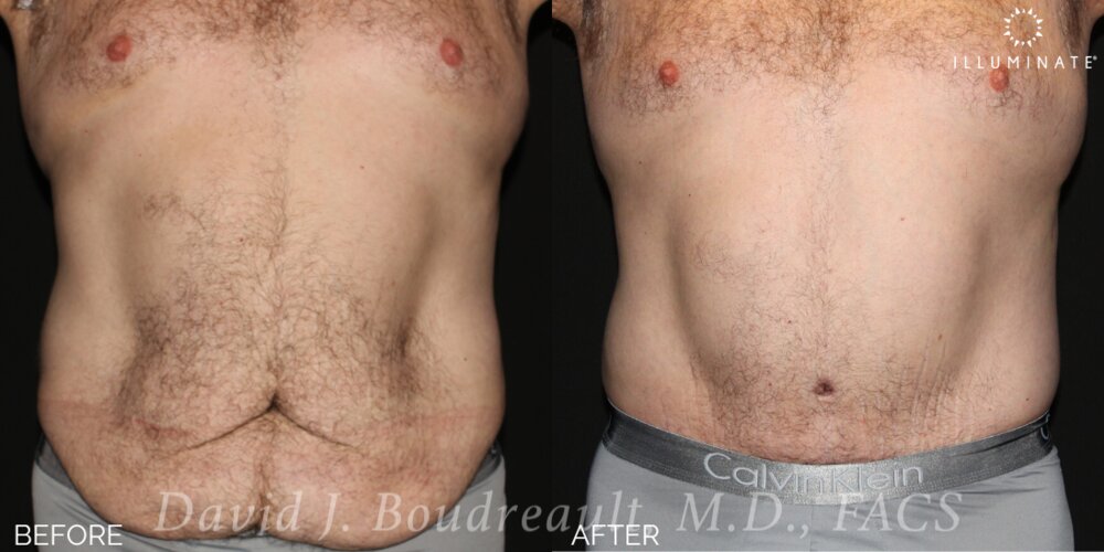 Tummy Tuck Before & After Image