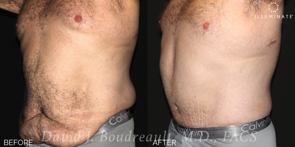 Tummy Tuck Before & After Image