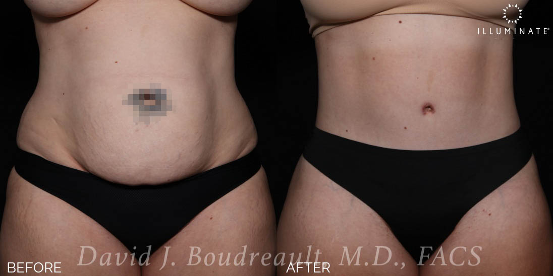 Tummy Tuck Before & After Image