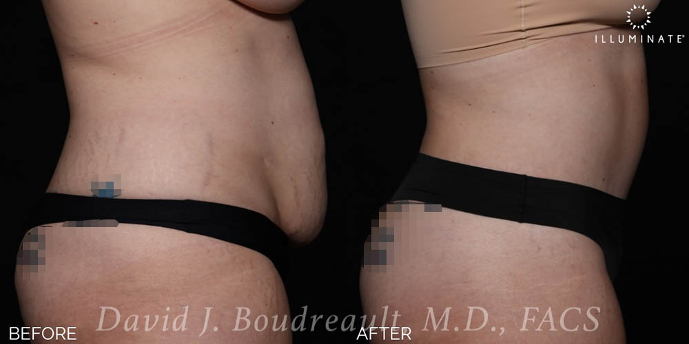 Tummy Tuck Before & After Image