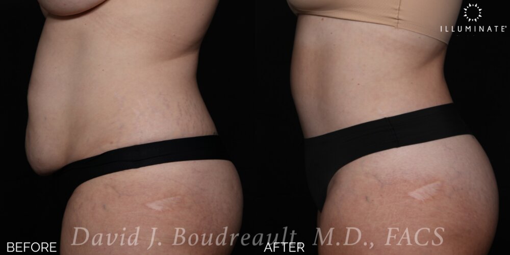 Tummy Tuck Before & After Image