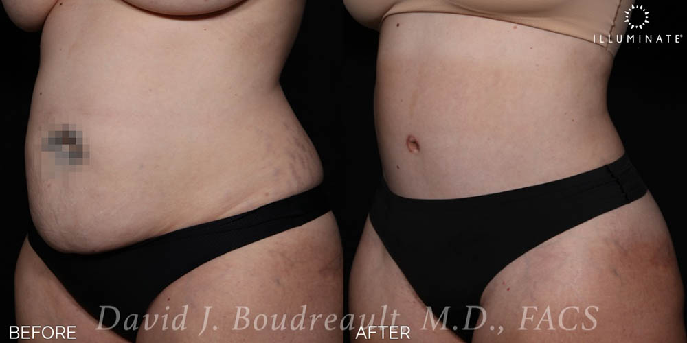 Tummy Tuck Before & After Image