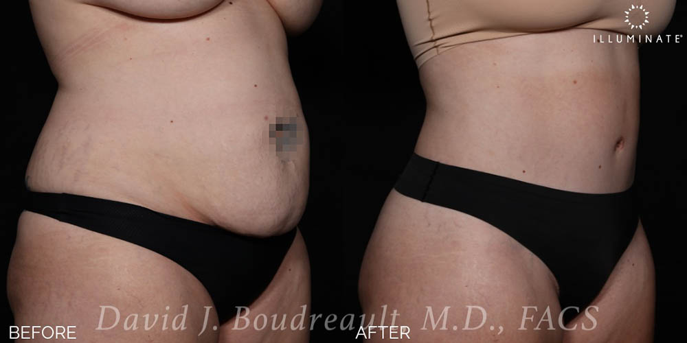 Tummy Tuck Before & After Image