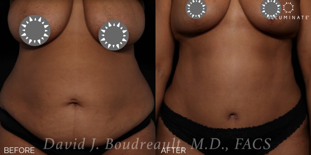 Tummy Tuck Before & After Image