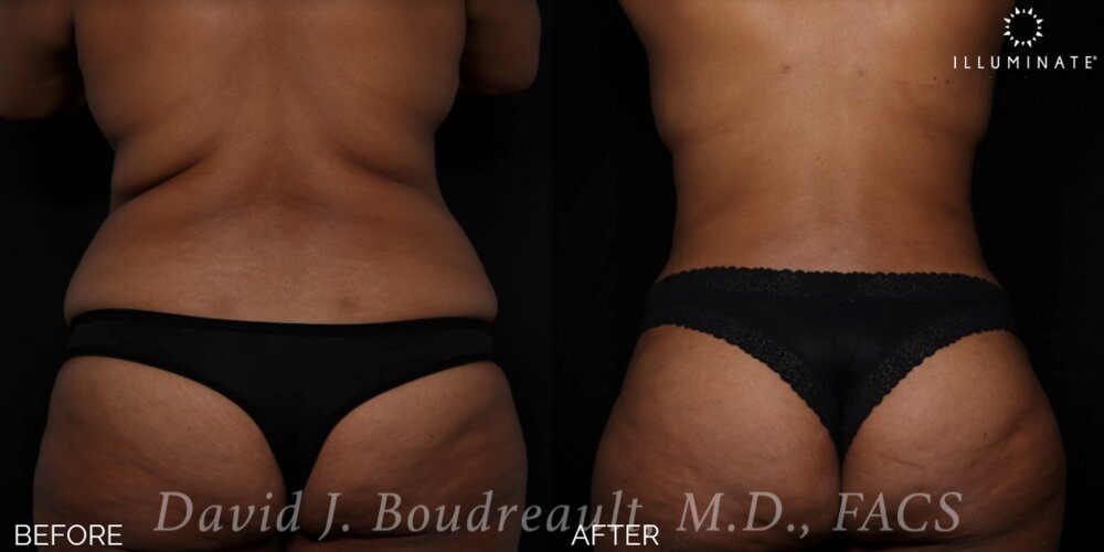 Tummy Tuck Before & After Image