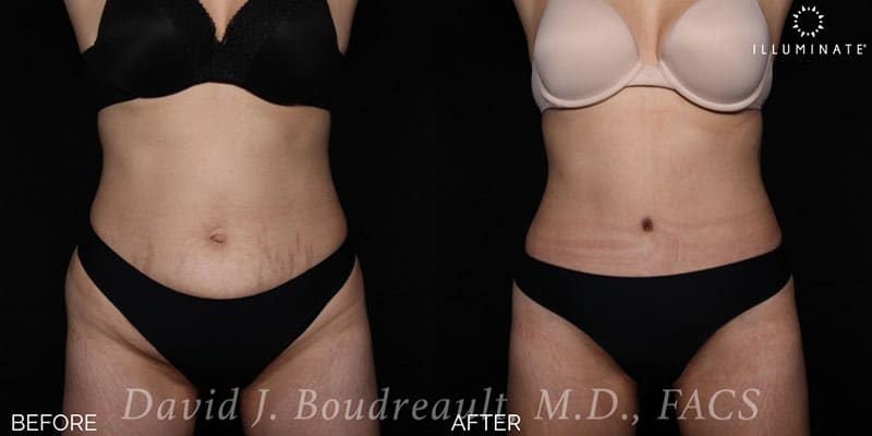 Tummy Tuck Before & After Image