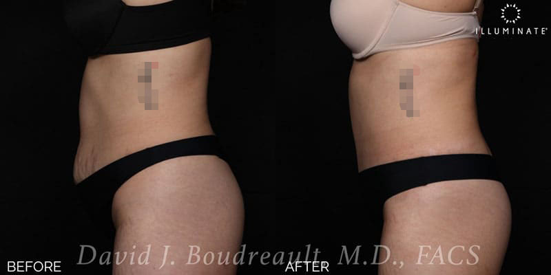 Tummy Tuck Before & After Image