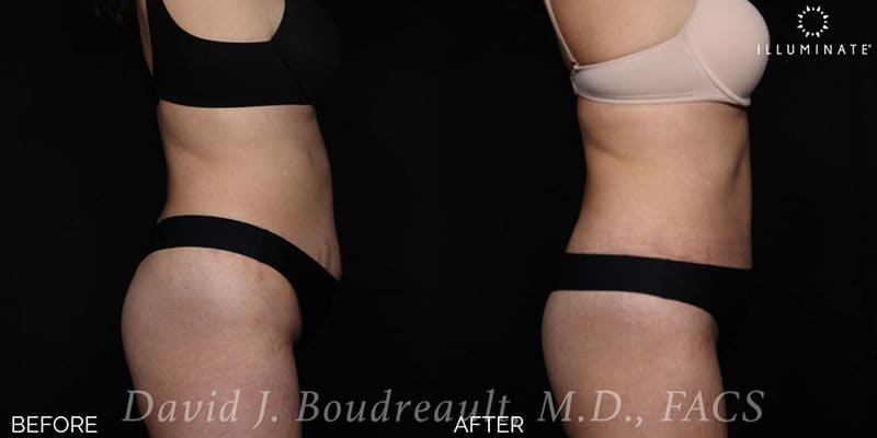 Tummy Tuck Before & After Image