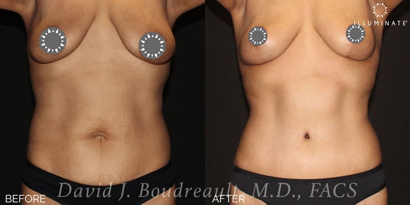 Tummy Tuck Before & After Image