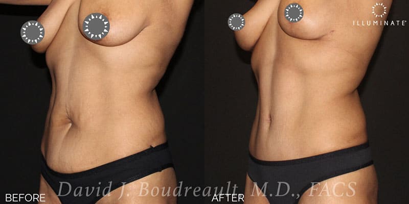 Tummy Tuck Before & After Image