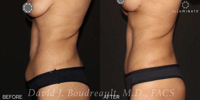 Tummy Tuck Before & After Image