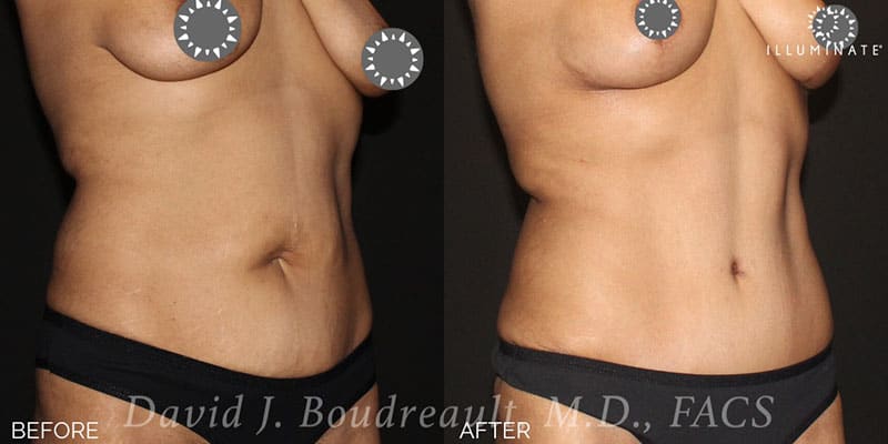 Tummy Tuck Before & After Image